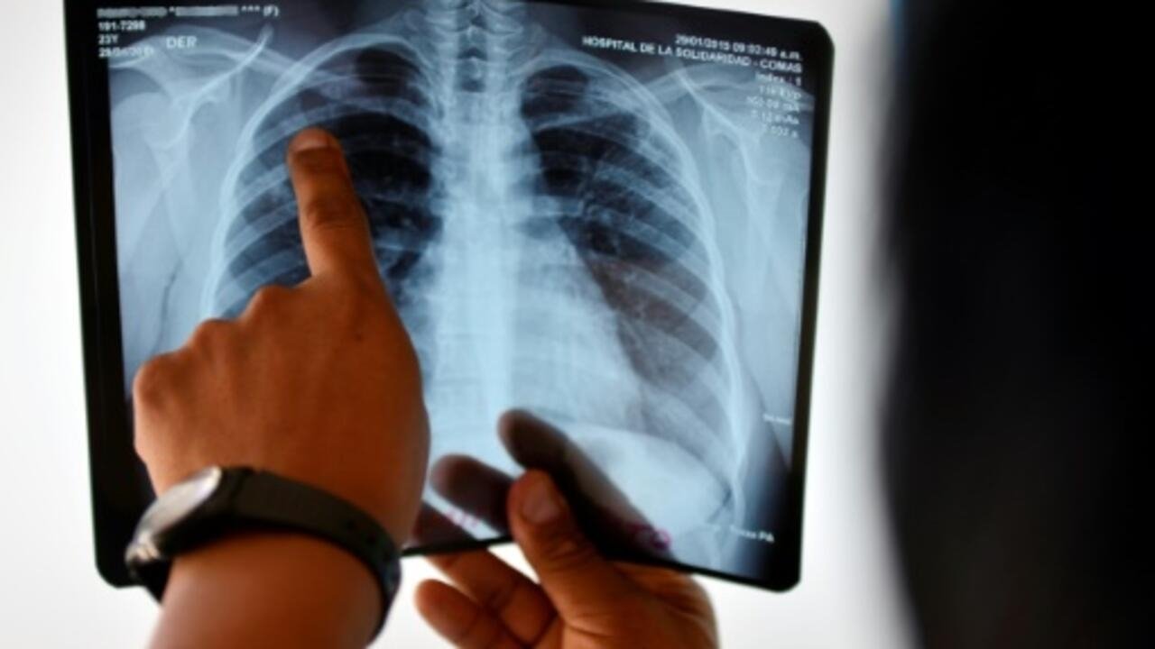 Après une accalmie pendant le Covid, la France voit les cas de tuberculose augmenter